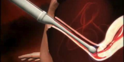 IVF - in vitro-fertilisering