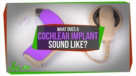 Hur låter cochleaimplantat?