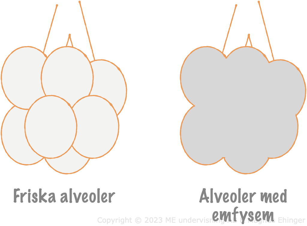 Friska alveoler och alveoler med emfysem.